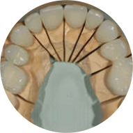 Implant Supported Crowns